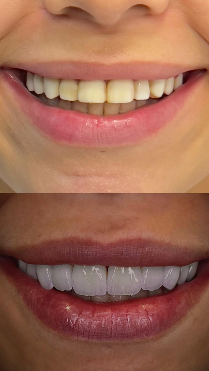 Antes e depois de reabilitação estética do sorriso
